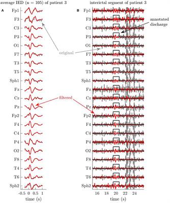 Semi-automated EEG Enhancement Improves Localization of Ictal Onset Zone With EEG-Correlated fMRI